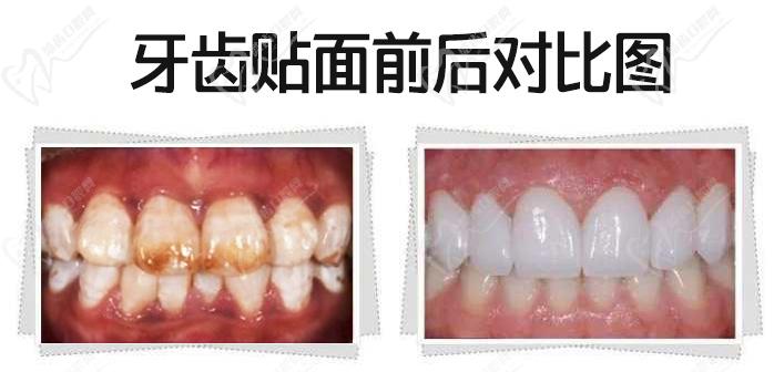 我做牙齒貼面5年后感受，看瓷貼面效果圖