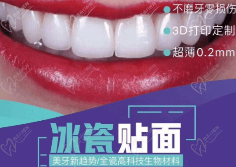 什么是冰瓷貼面？