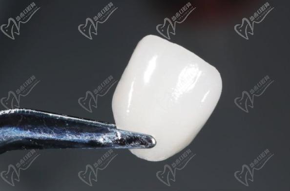 藍(lán)瓷貼面和鑄瓷貼面哪個(gè)好一點(diǎn)？