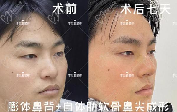 重慶李喆做鼻子怎么樣？口碑評(píng)價(jià)