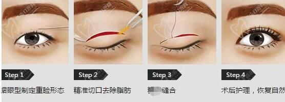 杜園園雙眼皮修復(fù)手術(shù)價(jià)格是多少錢(qián)
