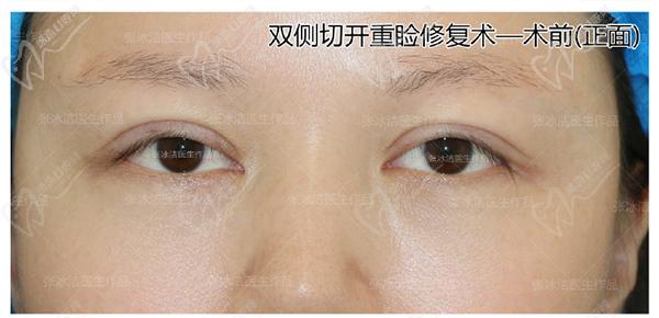張冰潔雙眼皮修復(fù)案 例圖：肉條腫過寬過深、睜眼費力眼睛無神