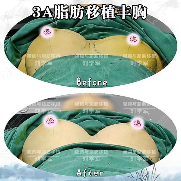 深圳劉學軍 醫(yī)生隆胸怎么樣