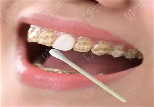 牙齒美白有哪些方法？