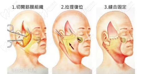 廣州黃廣香擅長什么手術