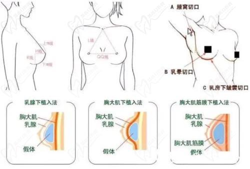 廣州黃廣香擅長隆胸手術