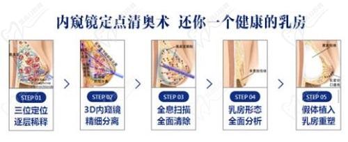 廣州黃廣香擅長清奧手術