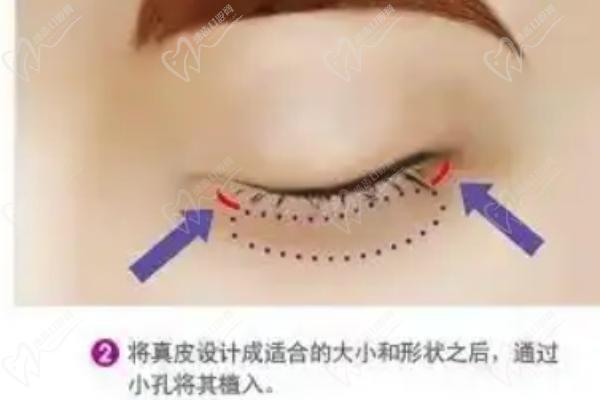 外眥修復(fù)、提升、成形術(shù)的區(qū)別與選擇