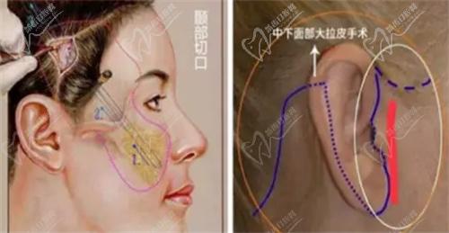 黃廣香和魏廣運拉皮技術特色與優(yōu)勢