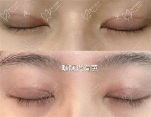 北京豐聯(lián)麗格醫(yī)療美容師麗麗修復(fù)雙眼皮怎么樣？