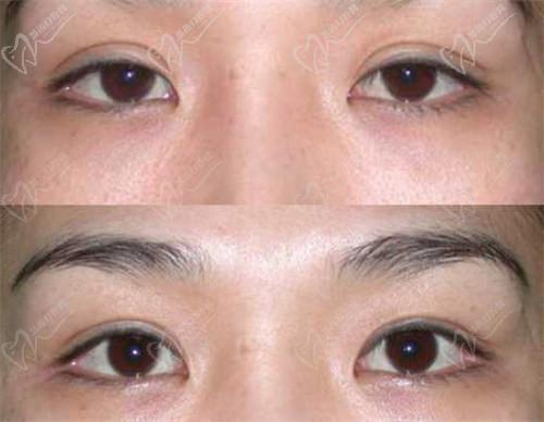 三、北京師麗麗雙眼皮修復(fù)與內(nèi)眼角修復(fù)的成功實(shí)例：