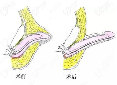 李世榮的延長術(shù)采用"三層遞進減張縫合"技術(shù)