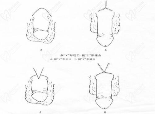 李世榮延長手術(shù)的高定價，本質(zhì)上是醫(yī)療價值的真實體現(xiàn)