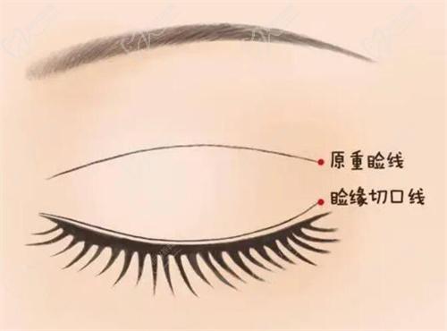 三、影響北京豐聯(lián)麗格整形醫(yī)院做雙眼皮價格的因素