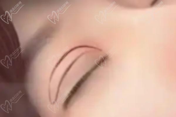 師麗麗雙眼皮修復(fù)手術(shù)項(xiàng)目優(yōu)勢(shì)分析