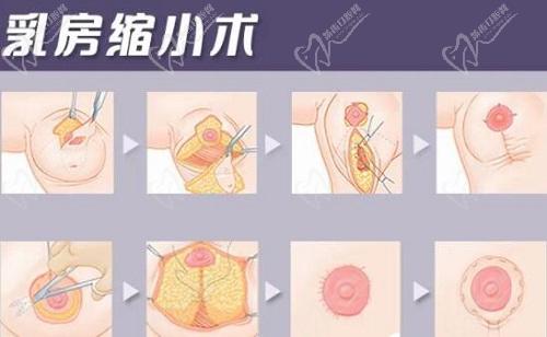 重慶劉正茂醫(yī)生縮胸怎么樣？