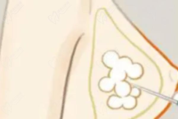 北京英煌間聯(lián)祖細胞豐胸的優(yōu)勢