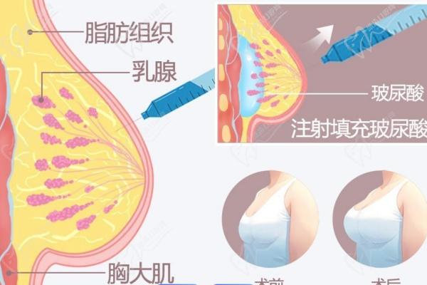 北京英煌間聯(lián)祖細胞豐胸