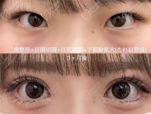 北京豐聯(lián)麗格醫(yī)療美容師麗麗修復(fù)雙眼皮怎么樣？肉條眼修復(fù)解決假寬深疤痕更隱形