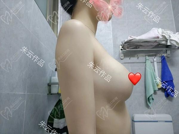 廣州朱云做胸怎么樣？是華南僅此一位做筋膜層隆胸的院長(zhǎng)名咖技術(shù)精妙口碑高