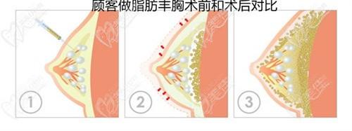 ?廣州朱云醫(yī)生擅長(zhǎng)筋膜層微痛隆胸/不良胸修復(fù)/自體脂肪復(fù)合隆胸，技術(shù)真的特別膩害！